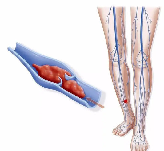 How to avoid venous thrombosis