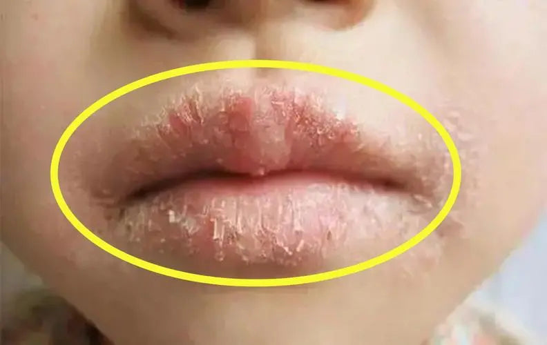 Are your lips chapped and flaky in winter? Don't lick it!